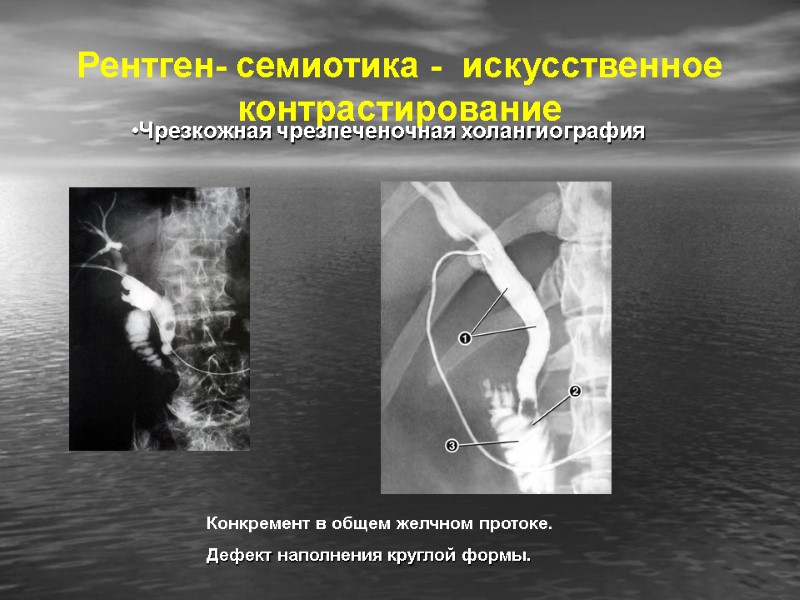 Рентген- семиотика -  искусственное контрастирование Чрезкожная чрезпеченочная холангиография Конкремент в общем желчном протоке.